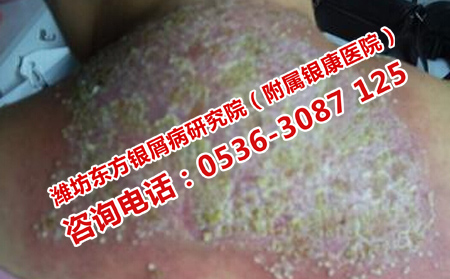银屑病的最新治疗方法揭秘，小巷深处的秘密小店探索