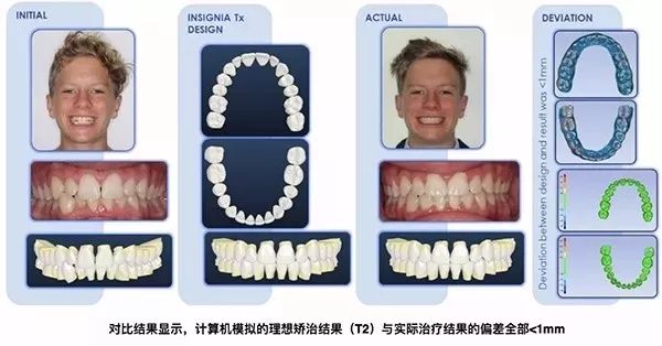 正畸最新技术，引领牙齿矫正新时代的革新之路